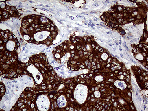 AGR2 Antibody - Immunohistochemical staining of paraffin-embedded Adenocarcinoma of Human breast tissue tissue using anti-AGR2 mouse monoclonal antibody. (Heat-induced epitope retrieval by 1mM EDTA in 10mM Tris buffer. (pH8.5) at 120°C for 3 min. (1:500)