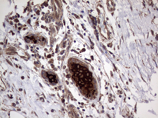 AGR2 Antibody - Immunohistochemical staining of paraffin-embedded Human breast tissue within the normal limits using anti-AGR2 mouse monoclonal antibody. (Heat-induced epitope retrieval by 1mM EDTA in 10mM Tris buffer. (pH8.5) at 120°C for 3 min. (1:2000)