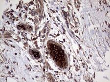 AGR2 Antibody - Immunohistochemical staining of paraffin-embedded Human breast tissue within the normal limits using anti-AGR2 mouse monoclonal antibody. (Heat-induced epitope retrieval by 1mM EDTA in 10mM Tris buffer. (pH8.5) at 120°C for 3 min. (1:2000)