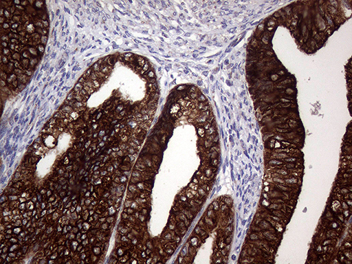 AGR2 Antibody - Immunohistochemical staining of paraffin-embedded Adenocarcinoma of Human endometrium tissue using anti-AGR2 mouse monoclonal antibody. (Heat-induced epitope retrieval by 1mM EDTA in 10mM Tris buffer. (pH8.5) at 120°C for 3 min. (1:2000)
