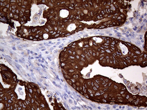 AGR2 Antibody - Immunohistochemical staining of paraffin-embedded Adenocarcinoma of Human breast tissue tissue using anti-AGR2 mouse monoclonal antibody. (Heat-induced epitope retrieval by 1mM EDTA in 10mM Tris buffer. (pH8.5) at 120°C for 3 min. (1:2000)