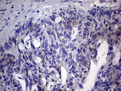 AGR2 Antibody - Immunohistochemical staining of paraffin-embedded Adenocarcinoma of Human ovary tissue using anti-AGR2 mouse monoclonal antibody. (Heat-induced epitope retrieval by 1mM EDTA in 10mM Tris buffer. (pH8.5) at 120°C for 3 min. (1:2000)