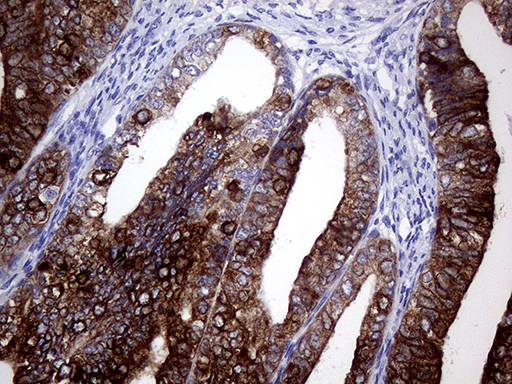 AGR2 Antibody - Immunohistochemical staining of paraffin-embedded Adenocarcinoma of Human endometrium tissue using anti-AGR2 mouse monoclonal antibody. (Heat-induced epitope retrieval by 1mM EDTA in 10mM Tris buffer. (pH8.5) at 120°C for 3 min. (1:2000)