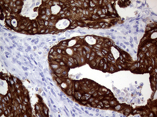 AGR2 Antibody - Immunohistochemical staining of paraffin-embedded Adenocarcinoma of Human breast tissue tissue using anti-AGR2 mouse monoclonal antibody. (Heat-induced epitope retrieval by 1mM EDTA in 10mM Tris buffer. (pH8.5) at 120°C for 3 min. (1:2000)