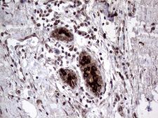 AGR2 Antibody - Immunohistochemical staining of paraffin-embedded Human breast tissue within the normal limits using anti-AGR2 mouse monoclonal antibody. (Heat-induced epitope retrieval by 1mM EDTA in 10mM Tris buffer. (pH8.5) at 120°C for 3 min. (1:2000)