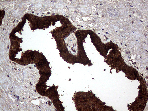 AGR2 Antibody - Immunohistochemical staining of paraffin-embedded Carcinoma of Human prostate tissue using anti-AGR2 mouse monoclonal antibody. (Heat-induced epitope retrieval by 1mM EDTA in 10mM Tris buffer. (pH8.5) at 120°C for 3 min. (1:2000)