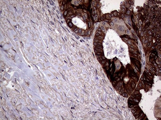 AGR2 Antibody - Immunohistochemical staining of paraffin-embedded Adenocarcinoma of Human ovary tissue using anti-AGR2 mouse monoclonal antibody. (Heat-induced epitope retrieval by 1mM EDTA in 10mM Tris buffer. (pH8.5) at 120°C for 3 min. (1:2000)