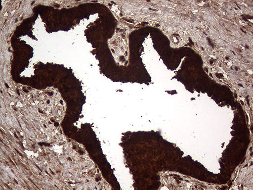 AGR2 Antibody - Immunohistochemical staining of paraffin-embedded Carcinoma of Human prostate tissue using anti-AGR2 mouse monoclonal antibody. (Heat-induced epitope retrieval by 1mM EDTA in 10mM Tris buffer. (pH8.5) at 120°C for 3 min. (1:2000)