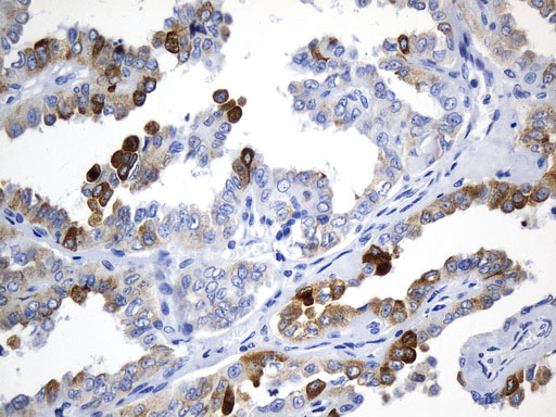 AGR2 Antibody - Immunohistochemical staining of paraffin-embedded Carcinoma of Human thyroid tissue using anti-AGR2 mouse monoclonal antibody. (Heat-induced epitope retrieval by 1mM EDTA in 10mM Tris buffer. (pH8.5) at 120°C for 3 min. (1:500)