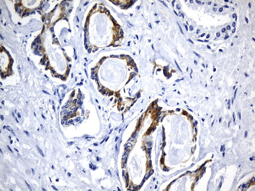 AGR2 Antibody - Immunohistochemical staining of paraffin-embedded Carcinoma of Human prostate tissue using anti-AGR2 mouse monoclonal antibody. (Heat-induced epitope retrieval by 1mM EDTA in 10mM Tris buffer. (pH8.5) at 120°C for 3 min. (1:500)