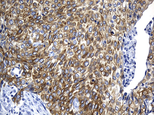 AGR2 Antibody - Immunohistochemical staining of paraffin-embedded Carcinoma of Human bladder tissue using anti-AGR2 mouse monoclonal antibody. (Heat-induced epitope retrieval by 1mM EDTA in 10mM Tris buffer. (pH8.5) at 120°C for 3 min. (1:500)