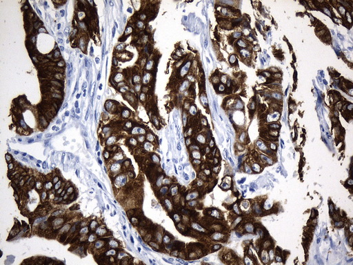AGR2 Antibody - Immunohistochemical staining of paraffin-embedded Adenocarcinoma of Human colon tissue using anti-AGR2 mouse monoclonal antibody. (Heat-induced epitope retrieval by 1mM EDTA in 10mM Tris buffer. (pH8.5) at 120°C for 3 min. (1:500)