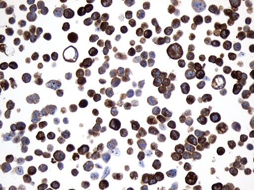 AGR2 Antibody - Immunohistochemical staining of paraffin-embedded MDA-MB-453 cell pellets using anti-AGR2 mouse monoclonal antibody. (Heat-induced epitope retrieval by 1mM EDTA in 10mM Tris buffer. (pH8.0) at 120°C for 2.5 min. (1:500)