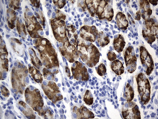 AGR2 Antibody - Immunohistochemical staining of paraffin-embedded Human Gastric Carcinoma using anti-AGR2 mouse monoclonal antibody. (Heat-induced epitope retrieval by 1mM EDTA in 10mM Tris buffer. (pH8.5) at 120°C for 3 min. (1:500)