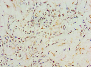 AGR2 Antibody - Immunohistochemistry of paraffin-embedded human breast cancer using antibody at 1:100 dilution.