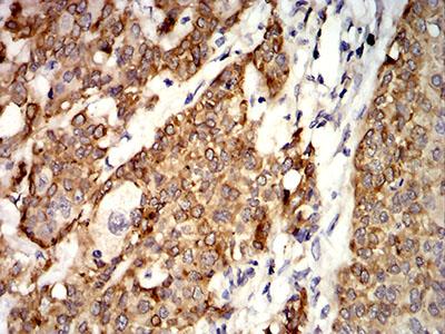 AGR2 Antibody - Immunohistochemical analysis of paraffin-embedded bladder cancer tissues using AGR2 mouse mAb with DAB staining.