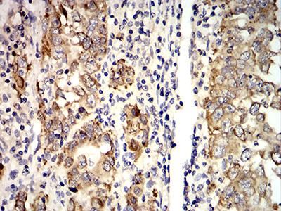 AGR2 Antibody - Immunohistochemical analysis of paraffin-embedded stomach cancer tissues using AGR2 mouse mAb with DAB staining.