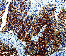 AGR2 Antibody - Immunohistochemistry of paraffin-embedded Human renal cancer using AGR2 Polyclonal Antibody at dilution of 1:10.