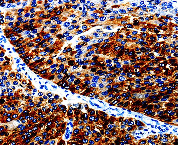 AGR2 Antibody - Immunohistochemistry of paraffin-embedded Human renal cancer using AGR2 Polyclonal Antibody at dilution of 1:10.
