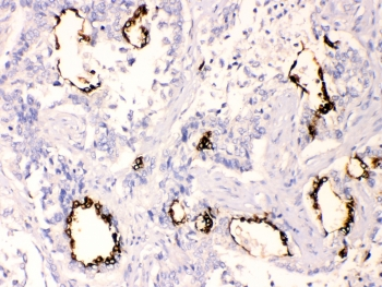 AGR2 Antibody - IHC testing of FFPE human lung cancer tissue with AGR2 antibody at 1ug/ml. Required HIER: steam section in pH6 citrate buffer for 20 min and allow to cool prior to testing.