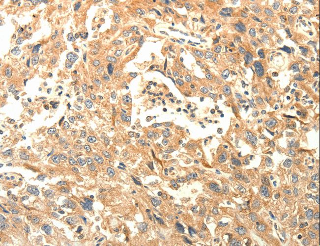 AGRN / Agrin Antibody - Immunohistochemistry of paraffin-embedded Human lung cancer using AGRN Polyclonal Antibody at dilution of 1:30.
