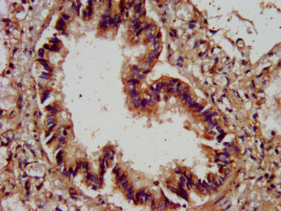 AGRN / Agrin Antibody - IHC image of AGRN Antibody diluted at 1:400 and staining in paraffin-embedded human lung tissue performed on a Leica BondTM system. After dewaxing and hydration, antigen retrieval was mediated by high pressure in a citrate buffer (pH 6.0). Section was blocked with 10% normal goat serum 30min at RT. Then primary antibody (1% BSA) was incubated at 4°C overnight. The primary is detected by a biotinylated secondary antibody and visualized using an HRP conjugated SP system.