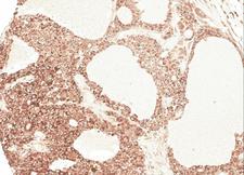AGT / Angiotensinogen Antibody - IHC of paraffin-embedded Hepatocellular carcinoma Huh7 xenograft using AGT antibody at 1:100 dilution.