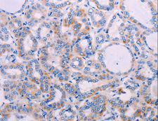 AGT / Angiotensinogen Antibody - Immunohistochemistry of paraffin-embedded Human thyroid cancer using AGT Polyclonal Antibody at dilution of 1:30.