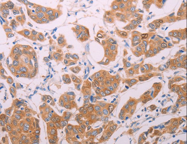 AGT / Angiotensinogen Antibody - Immunohistochemistry of paraffin-embedded Human breast cancer using AGT Polyclonal Antibody at dilution of 1:30.