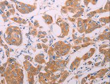 AGT / Angiotensinogen Antibody - Immunohistochemistry of paraffin-embedded Human breast cancer using AGT Polyclonal Antibody at dilution of 1:30.