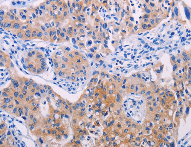 AGT / Angiotensinogen Antibody - Immunohistochemistry of paraffin-embedded Human lung cancer using AGT Polyclonal Antibody at dilution of 1:30.