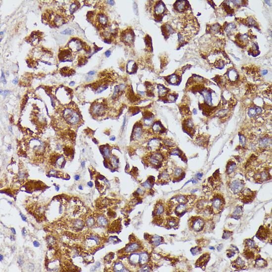 AGT / Angiotensinogen Antibody - Immunohistochemistry of paraffin-embedded Human liver cancer using AGT Polyclonal Antibody at dilution of 1:100 (40x lens).
