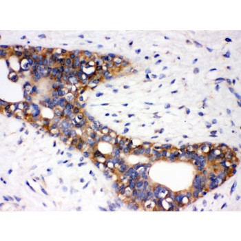 AGTR1 / AT1 Receptor Antibody - AGTR1 antibody IHC-paraffin. IHC(P): Human Mammary Cancer Tissue.