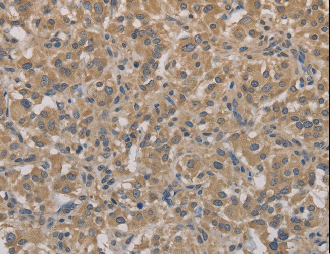 AGTRAP / ATRAP Antibody - Immunohistochemistry of paraffin-embedded Human gastric cancer using AGTRAP Polyclonal Antibody at dilution of 1:40.