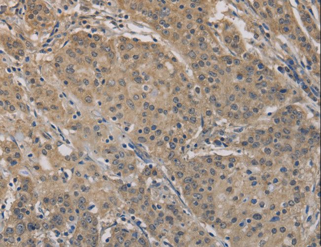AGTRAP / ATRAP Antibody - Immunohistochemistry of paraffin-embedded Human gastric cancer using AGTRAP Polyclonal Antibody at dilution of 1:40.