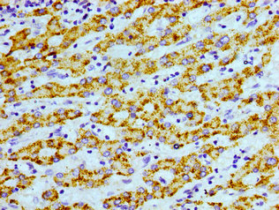 AGXT / SPT Antibody - Immunohistochemistry image of paraffin-embedded human liver cancer at a dilution of 1:100