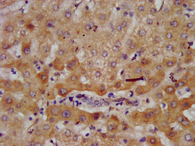 AGXT2 Antibody - IHC image of AGXT2 Antibody diluted at 1:700 and staining in paraffin-embedded human liver tissue performed on a Leica BondTM system. After dewaxing and hydration, antigen retrieval was mediated by high pressure in a citrate buffer (pH 6.0). Section was blocked with 10% normal goat serum 30min at RT. Then primary antibody (1% BSA) was incubated at 4°C overnight. The primary is detected by a biotinylated secondary antibody and visualized using an HRP conjugated SP system.