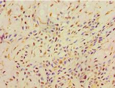 AHCYL1 / DCAL Antibody - Immunohistochemistry of paraffin-embedded human breast cancer using antibody at 1:100 dilution.