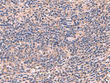 AHCYL1 / DCAL Antibody - Immunohistochemistry of paraffin-embedded Human cervical cancer tissue  using AHCYL1 Polyclonal Antibody at dilution of 1:70(×200)