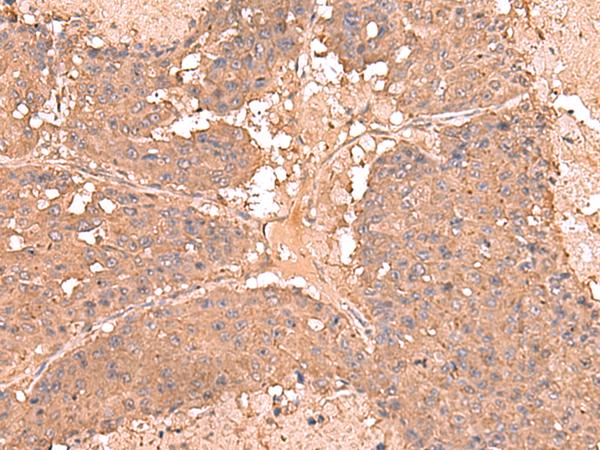 AHCYL1 / DCAL Antibody - Immunohistochemistry of paraffin-embedded Human liver cancer tissue  using AHCYL1 Polyclonal Antibody at dilution of 1:65(×200)