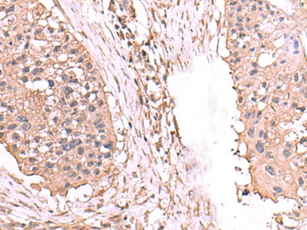 AHCYL1 / DCAL Antibody - Immunohistochemistry of paraffin-embedded Human esophagus cancer tissue  using AHCYL1 Polyclonal Antibody at dilution of 1:65(×200)