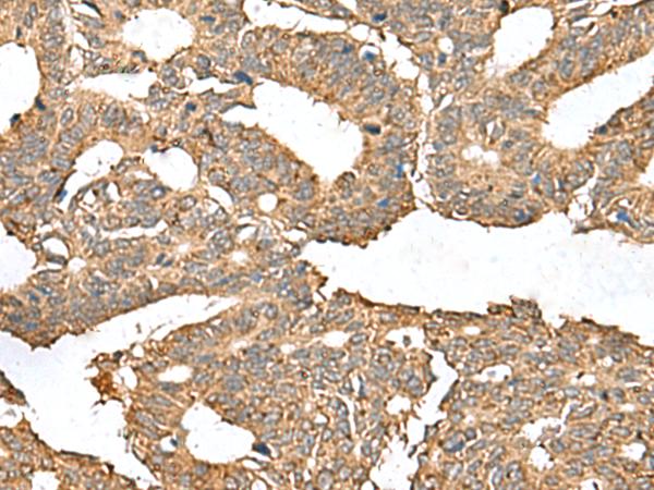AHNAK Antibody - Immunohistochemistry of paraffin-embedded Human colorectal cancer tissue  using AHNAK Polyclonal Antibody at dilution of 1:50(×200)
