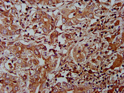AHNAK2 Antibody - Immunohistochemistry image at a dilution of 1:400 and staining in paraffin-embedded human liver cancer performed on a Leica BondTM system. After dewaxing and hydration, antigen retrieval was mediated by high pressure in a citrate buffer (pH 6.0) . Section was blocked with 10% normal goat serum 30min at RT. Then primary antibody (1% BSA) was incubated at 4 °C overnight. The primary is detected by a biotinylated secondary antibody and visualized using an HRP conjugated SP system.
