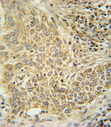 AHR Antibody - AHR Antibody immunohistochemistry of formalin-fixed and paraffin-embedded human lung carcinoma followed by peroxidase-conjugated secondary antibody and DAB staining.
