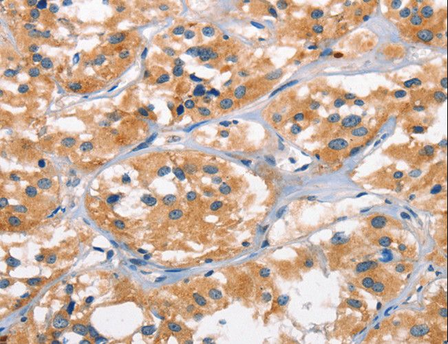 AHR Antibody - Immunohistochemistry of paraffin-embedded Human cervical cancer using AHR Polyclonal Antibody at dilution of 1:50.