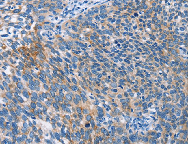 AHR Antibody - Immunohistochemistry of paraffin-embedded Human cervical cancer using AHR Polyclonal Antibody at dilution of 1:50.