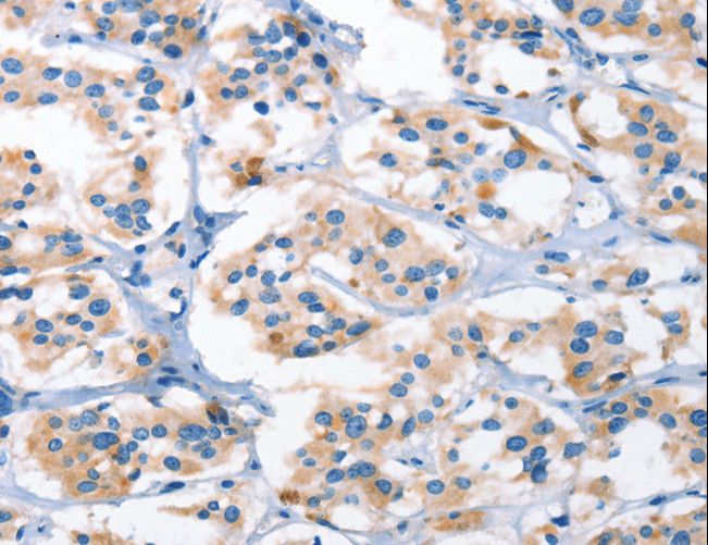 AHR Antibody - Immunohistochemistry of paraffin-embedded Human thyroid cancer using AHR Polyclonal Antibody at dilution of 1:50.