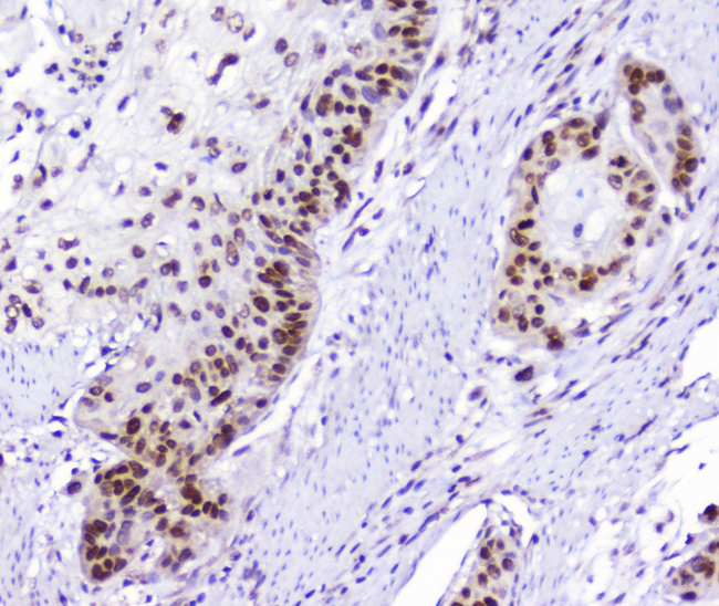 AHR Antibody - IHC analysis of AHR using anti-AHR antibody. AHR was detected in paraffin-embedded section of human oesophagus squama cancer tissue. Heat mediated antigen retrieval was performed in citrate buffer (pH6, epitope retrieval solution) for 20 mins. The tissue section was blocked with 10% goat serum. The tissue section was then incubated with 2µg/ml rabbit anti-AHR Antibody overnight at 4°C. Biotinylated goat anti-rabbit IgG was used as secondary antibody and incubated for 30 minutes at 37°C. The tissue section was developed using Strepavidin-Biotin-Complex (SABC) with DAB as the chromogen.