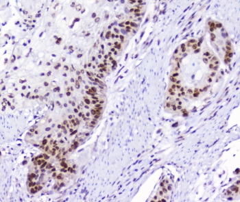 AHR Antibody - IHC staining of FFPE human esophagus squamous cancer with AHR antibody at 1ug/ml. HIER: boil tissue sections in pH6, 10mM citrate buffer, for 10-20 min followed by cooling at RT for 20 min.