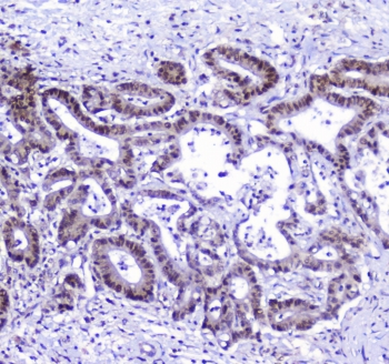 AHR Antibody - IHC staining of FFPE human cholangiocarcinoma with AHR antibody at 1ug/ml. HIER: boil tissue sections in pH6, 10mM citrate buffer, for 10-20 min followed by cooling at RT for 20 min.